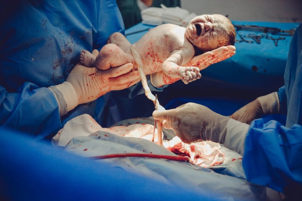 c-section birth